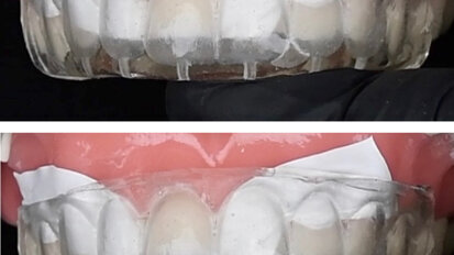 When using a silicone index in the flowable injection technique, the appearance of air bubbles can be avoided by ensuring that the index fits tightly to the tooth and is not moved during injection. (Image: Kuraray Noritake Dental)