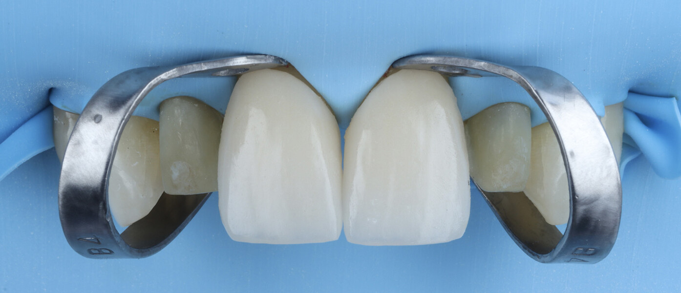 Fig. 13b: Verification of veneer fit with clamps in place to ensure complete seating. 