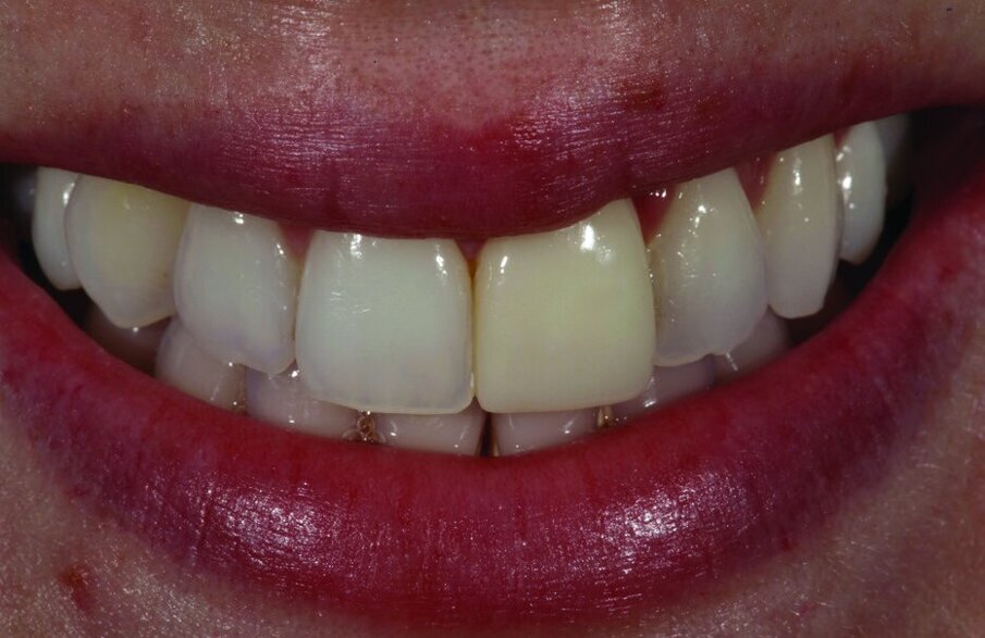 Fig. 1: After tooth whitening the composite resin crown on tooth 21 stood out unattractively.