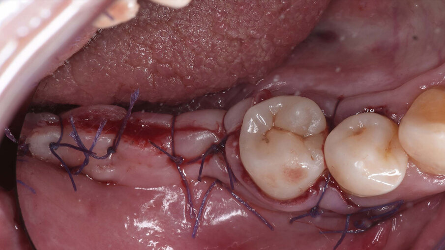 Fig. 7_Sutura ermetica del lembo di accesso mediante punti a materassaio orizzontale e punti singoli staccati, dopo l’esecuzione di rilasci periostali.