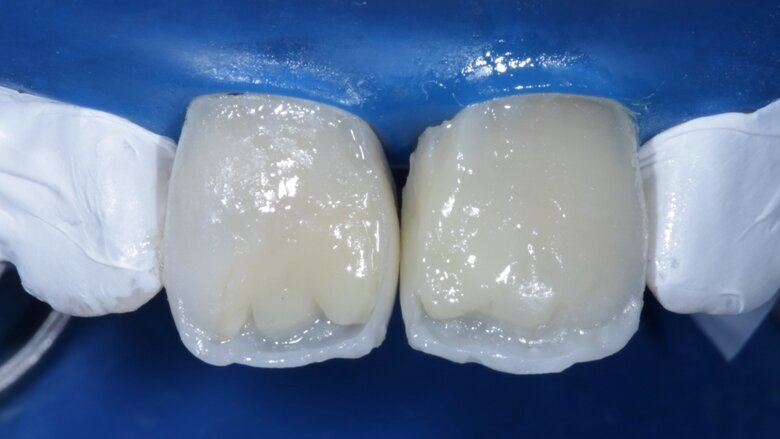Fig 13 light dentin shade placed above dark dentin