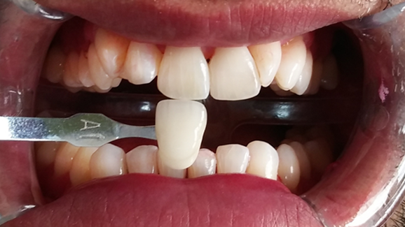 Zahnaufhellung nach Zahnreinigung wird zur Behandlung für Jedermann