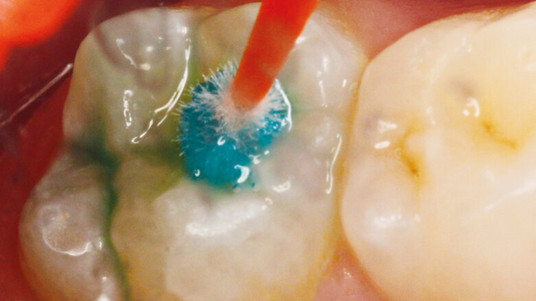 Skloionomerní pečetidla fisur k proaktivní intervenci