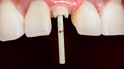 CAD/CAM-integrated glass fibre post and core restoration improves tooth fracture strength