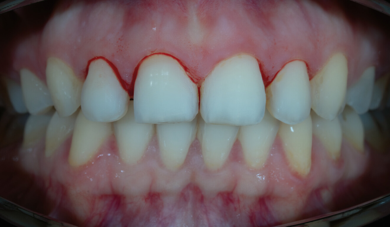 Fig. 3: Teeth after removal of the deficient veneers.