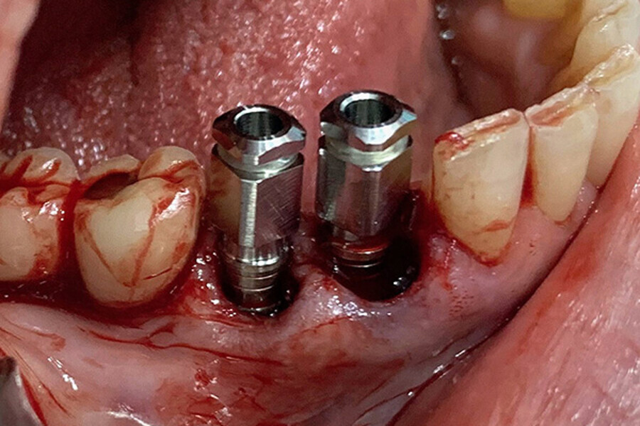 Figs. 9. Colocación de 2 implantes post-extracción en posiciones del 43 y 44 y control radiográfico post-extracción.