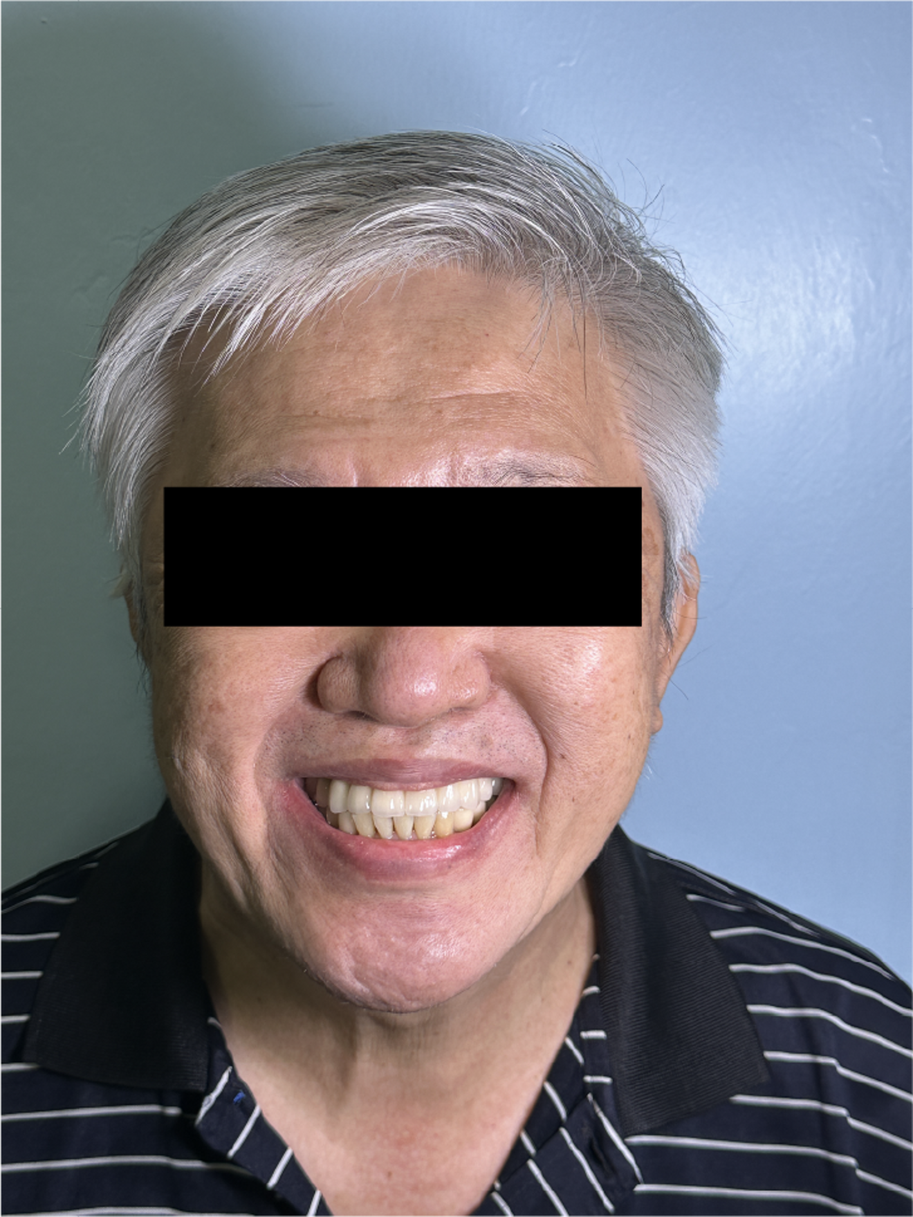  Fig. 3m: Frontal smile at rest showing the final aesthetic outcome following full-arch implant-supported rehabilitation.