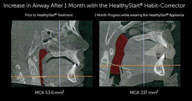 HealthyStart, a comprehensive pediatric airway system, offers online training