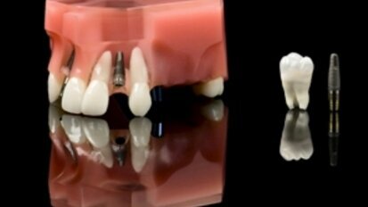 Cercetarile pe reptile dezvaluie secretele implanturilor dentare