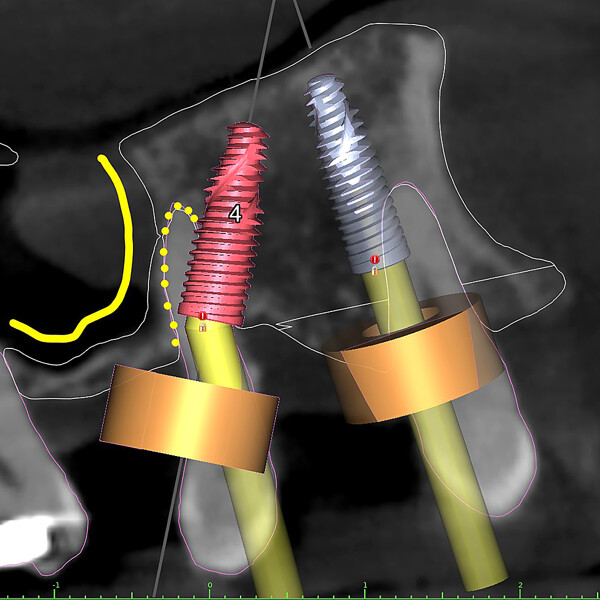 Figs. 5a–h: Cross-sectional simulated views of the implants in place, showing the implant lengths and diameters based on the CBCT scan data.