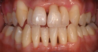 Le laser Er:YAG en maintenance parodontale sur les sites à risque