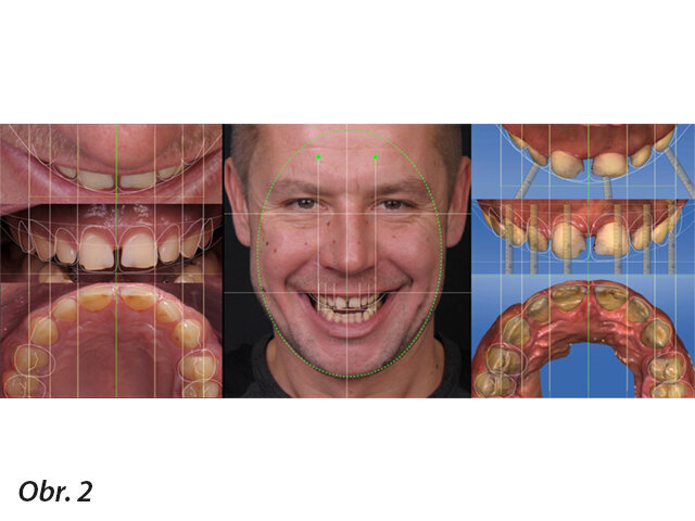 Obr. 2: Základní referenční linie na fotografii obličeje a na intraorálních fotografiích ve třech projekcích v programu Keynote. Jednoduché digitální analytické nástroje umožňují kreativní proces integrace úsměvu obličeje v souladu s charakterem i očekáváním pacienta, zjednodušují vizuální pochopení nesouladu mezi obličejem a okolím úst, kterými jsou: asymetrie, disharmonie a jiná porušení estetických pravidel. Díky procesu integrace mohou být referenční linie přeneseny na intraorální skeny (CEREC) a sloužit jako spojka mezi obličejem a digitálním pracovním modelem.