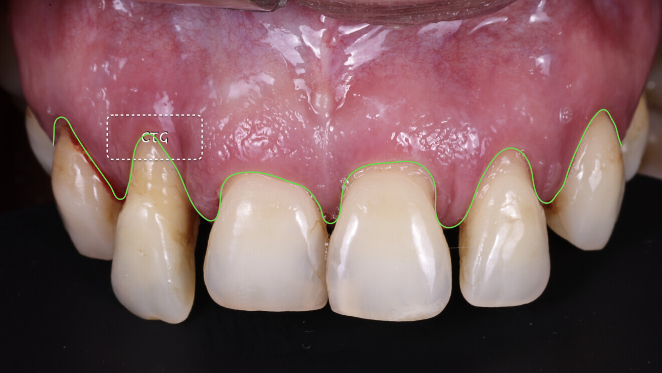 Fig. 4: Soft-tissue profile. We observed an excess of tissue overall except in the area of tooth #12, where a connective tissue graft (CTG) would be needed.
