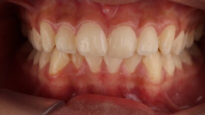 ClearX teen smile transformation