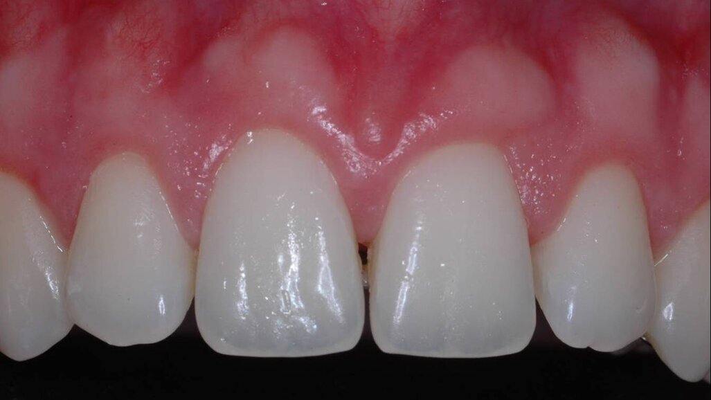 Процедури по удължаване на короните