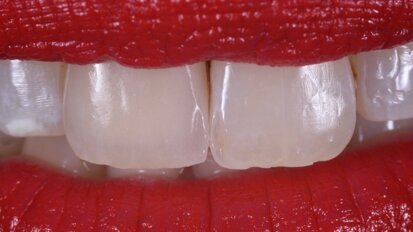 Ridge augmentation e impianto post estrattivo ritardato in un incisivo centrale