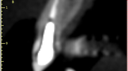 Fig. 2: The trajectory of the root
in relation to the alveolus can be visualised with a cross-sectional image.