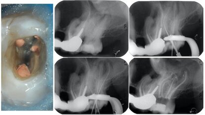 Webinar to showcase how to arrive at the correct working length