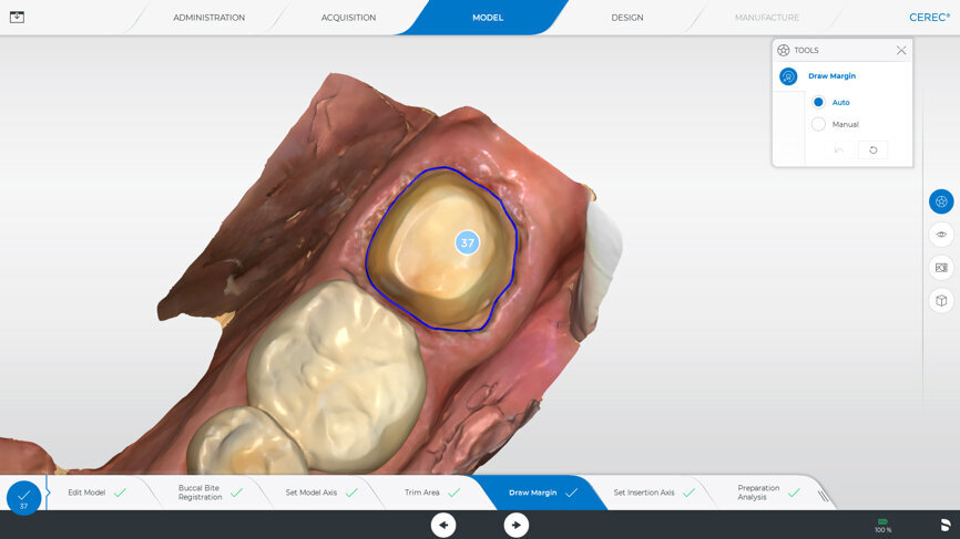 Fig. 3: The preparation margin is automatically delineated by the software, but if desired, it can be adjusted manually.