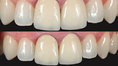 Caso clínico: Precisión del color con una nueva cerámica