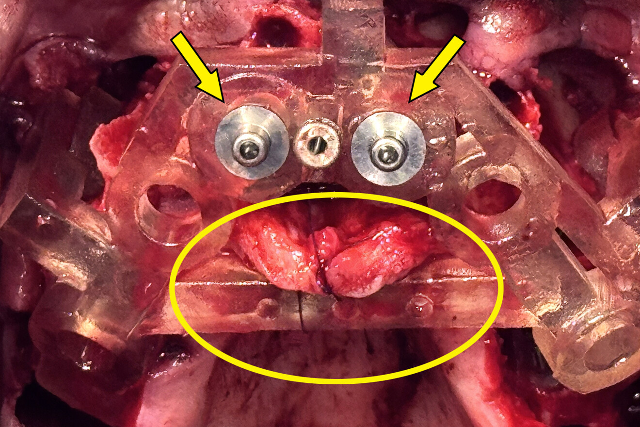 Fig. 11b: Horizontal stabilising bar (yellow oval) on the guide with holes to allow for suturing to retract the palatal tissue. Guide stabilisers (yellow arrows) immobilising the surgical guide.