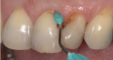 Empirical comparative study confirms thixotropic wound dressing for haemostasis