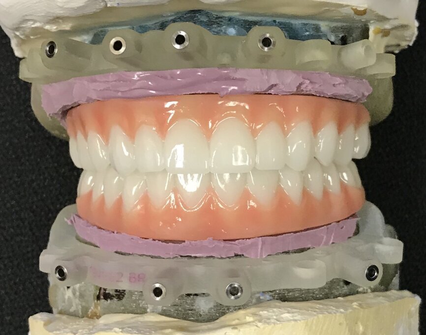Fig. 14: PMMA maxillary and mandibular restorations.