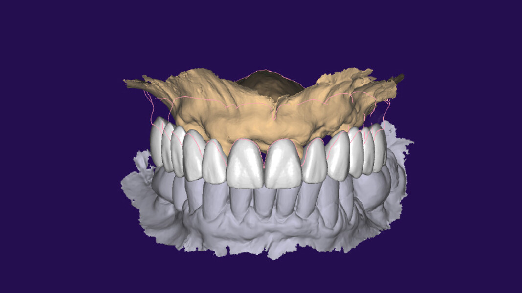 Fig. 12_Posizionamento degli attacchi Novaloc nel modello digitale e analogico, impostando un wax-up iniziale conforme alla morfologia dentale della paziente.