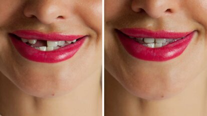 Nachwachsen neuer Zähne durch Medikament Nachwachsen neuer Zähne durch Medikament