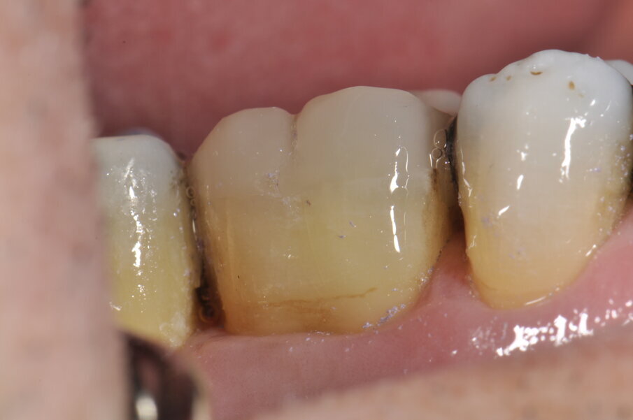 Fig. 12: Restauración acabada de pulir.