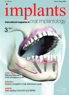 implants international No. 3, 2017 implants international No. 3, 2017
