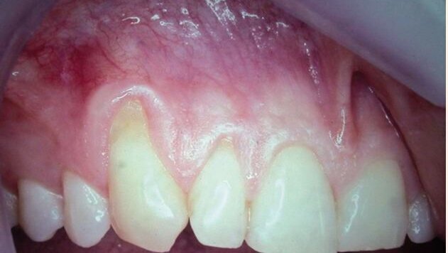 Le recouvrement de récession radiculaire devient prévisible, grâce à des membranes résorbables