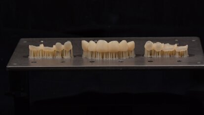 3D-printed provisional restorations for complex prosthetic rehabilitation: Full-mouth restoration of a severe case of erosion