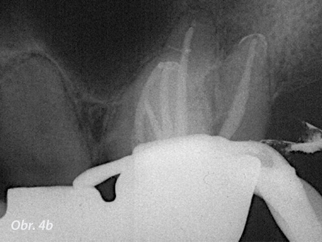 Pooperační RTG snímek