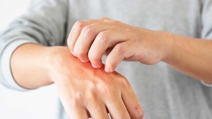 Studie bestätigt Zusammenhang zwischen Zahnagenesie und Dermatitis Studie bestätigt Zusammenhang zwischen Zahnagenesie und Dermatitis
