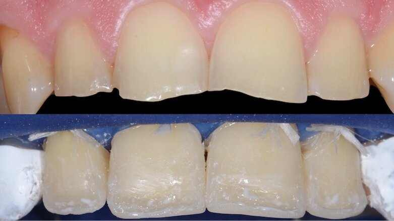 So gelingt die Bisshebung mit direkter Adhäsivtechnik
