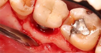 Ali lahko citronska kislina reši zobne vsadke, prizadete zaradi periimplantitisa?