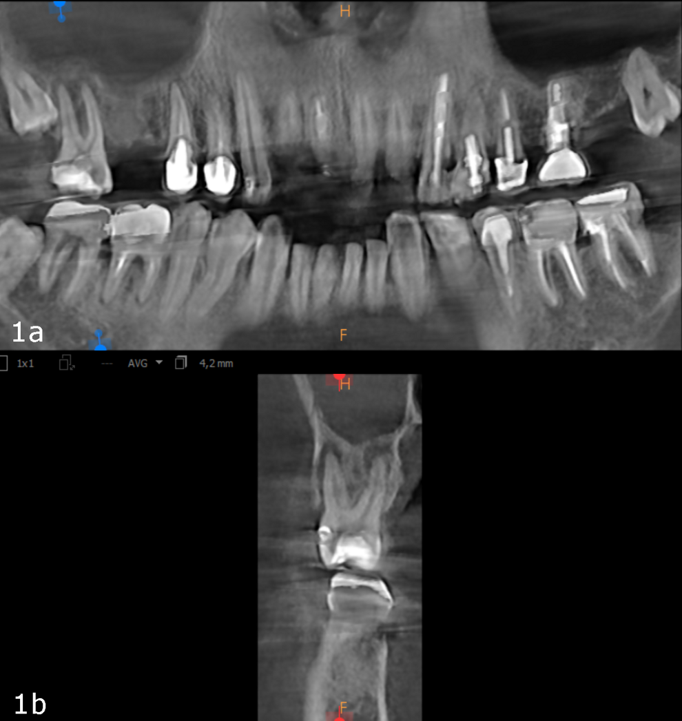 Figs. 1a & b: Initial small-volume CBCT scan, panoramic view (a) and cross-section of tooth #17 (b).