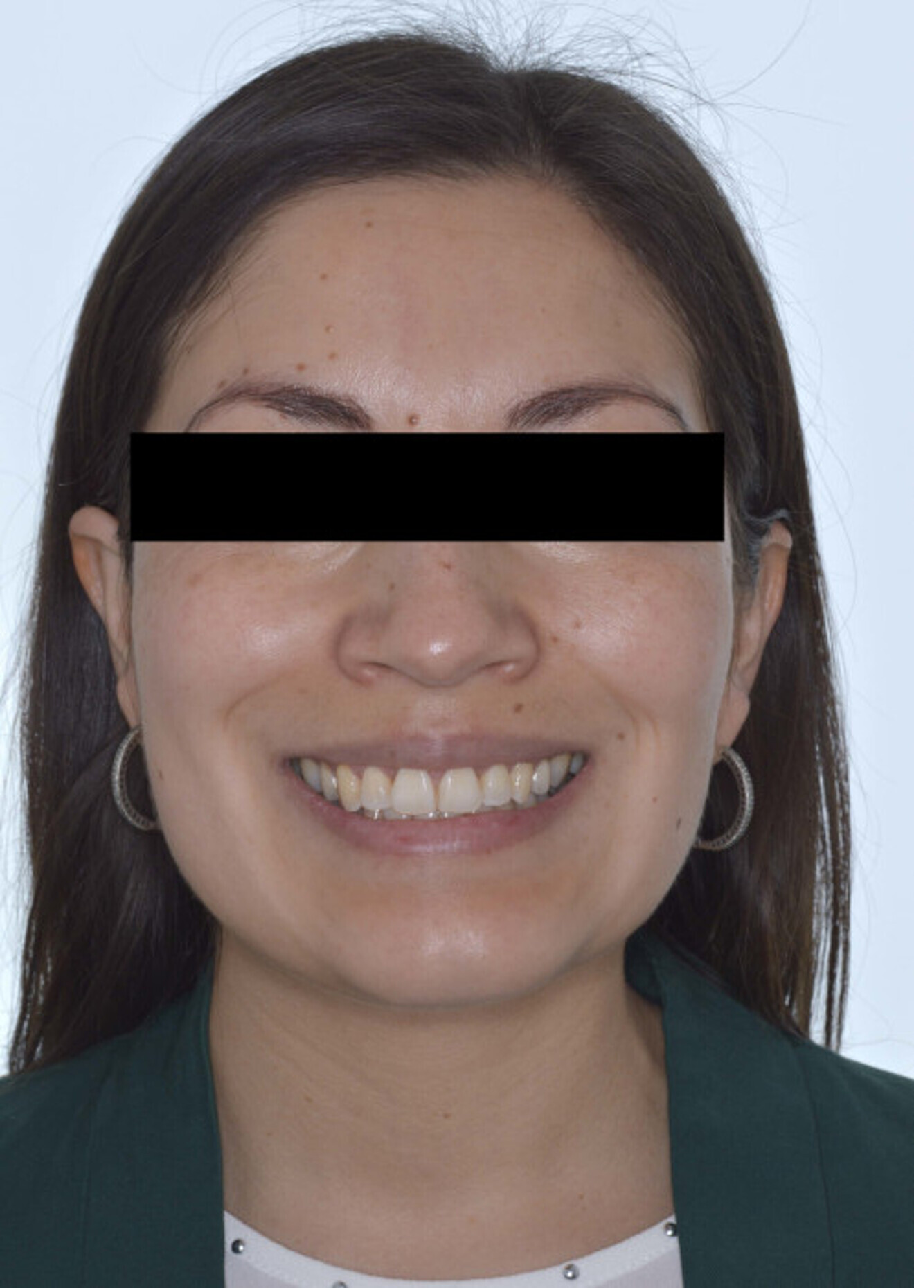 Fig. 12b: ... and after.