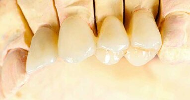 Study exploring accuracy of impression techniques finds partial vs. complete edentulism may be a confounding factor