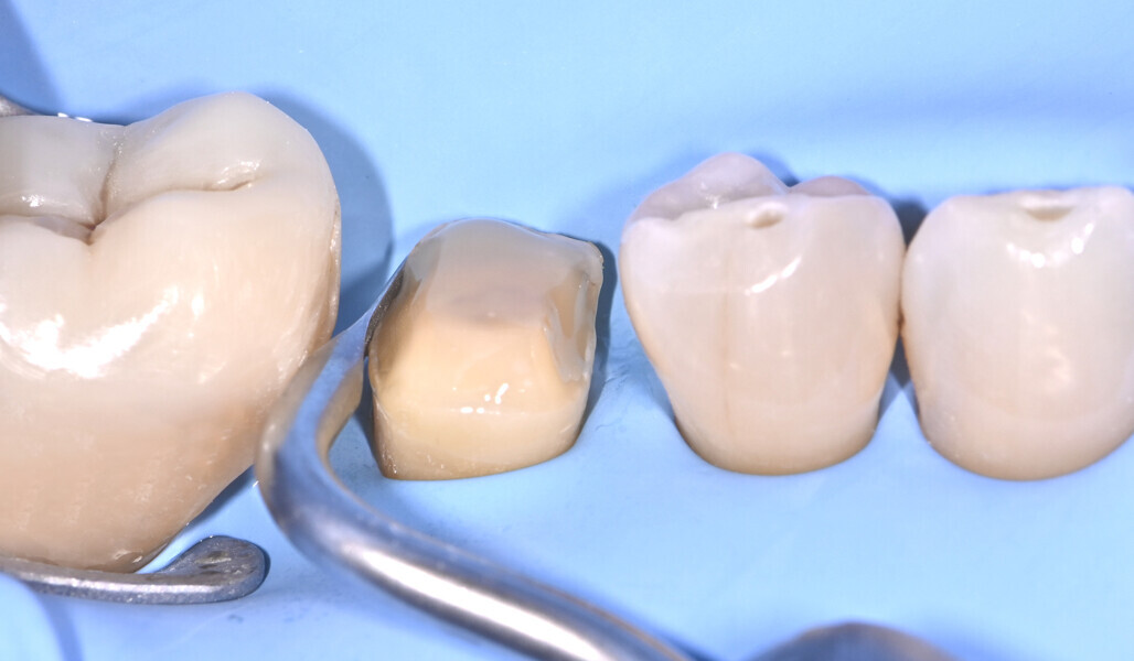 Fig. 6: Thin layer of flowable composite applied to the preparation. 