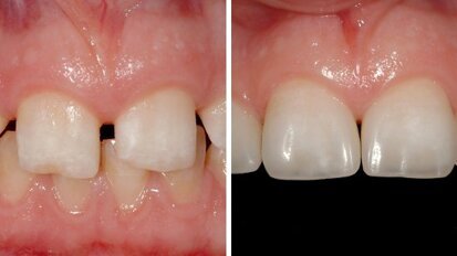 Aesthetic rehabilitation: Webinar discusses indications, limitations and clinical procedures