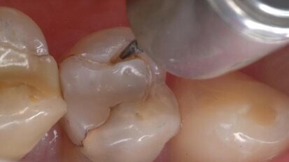 The perimeter preparation