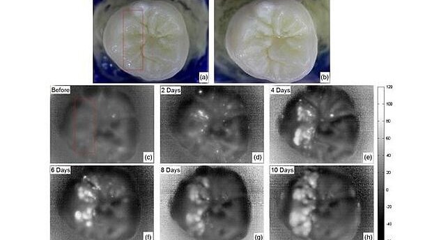 Nieuwe beeldvormende techniek kan vroege cariësdetectie bevorderen