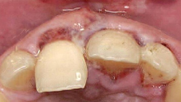 Augmentacja tkanek miękkich w strefie estetycznej za pomocą wielu warstw membrany kolagenowej