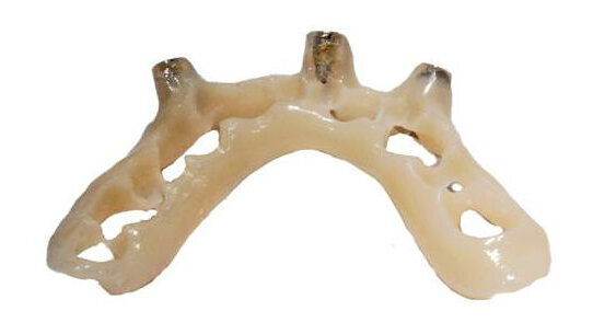 Il posizionatore guidato: modifiche della tecnica attuale  nella protesi implantare immediata