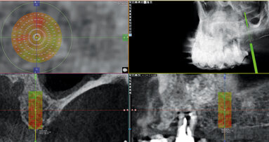 CBCT kostní denzitometrie pro rozhodování před chirurgickým zákrokem