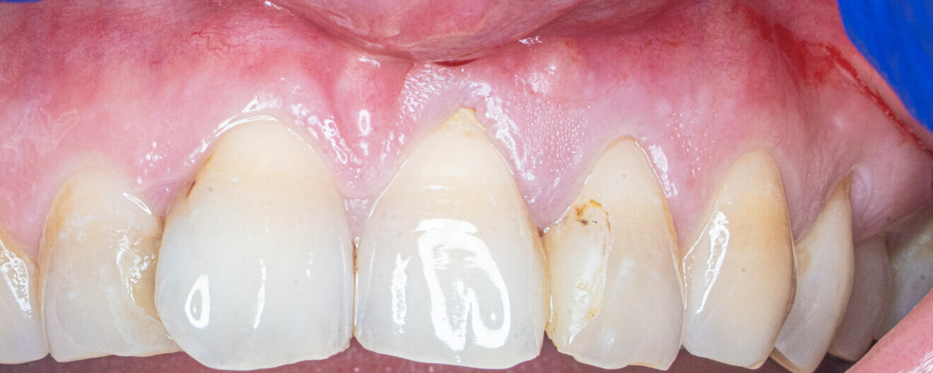 Fig. 2: Clinical situation before the treatment.
