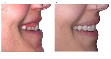 Piano di trattamento digitale in un caso di agenesia dentale multipla anteriore