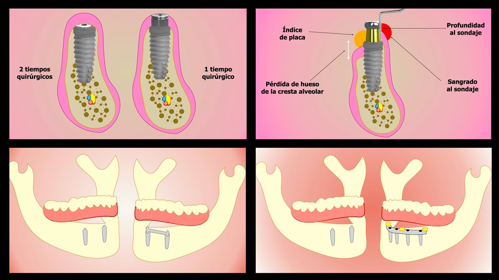 Carga inmediata o diferida en la mandíbula completamente edéntula